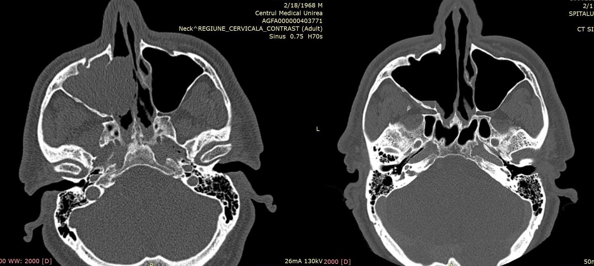 Cancerul foselor nazale și al sinusurilor paranazale | Spitalul Monza