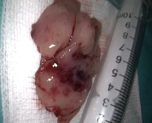 PLASMOCITOM SOLITAR EXTRAMEDULAR SEPTAL 