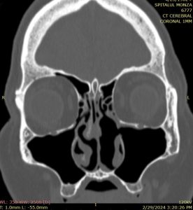 PLASMOCITOM SOLITAR EXTRAMEDULAR SEPTAL ASPECT POSTOPERATOR