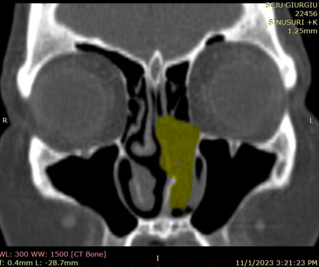 PLASMOCITOM SOLITAR EXTRAMEDULAR SEPTAL